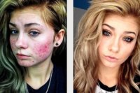 18-insane-acne-transformations-that-prove-the-pow-2-6423-1445540824-5_dblbig.jpg