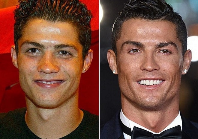 Cristiano-Ronaldo-Before-and-After-Nose-min.jpg