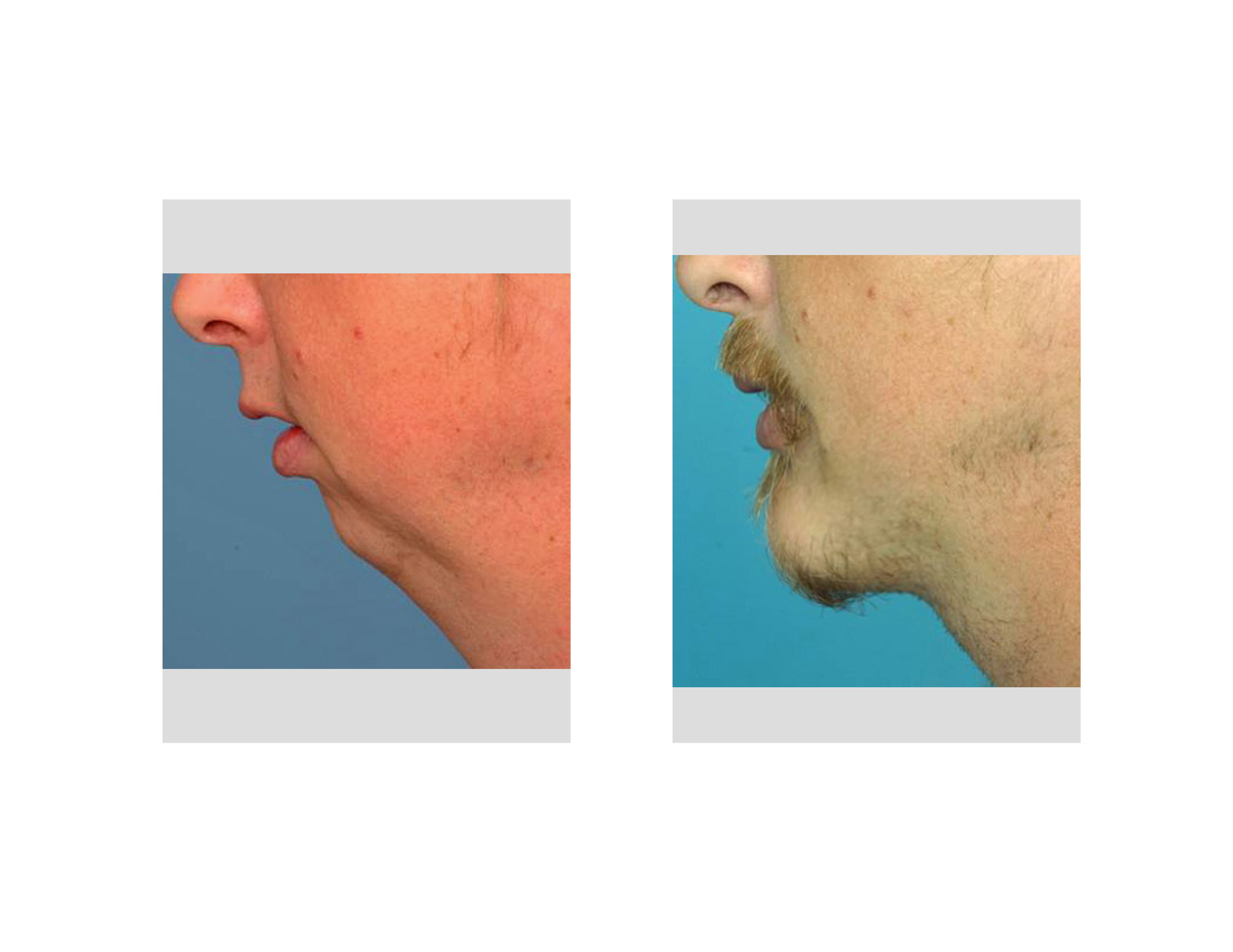 chin-augmentation-results-dr-barry-eppley-indianapolis.jpg