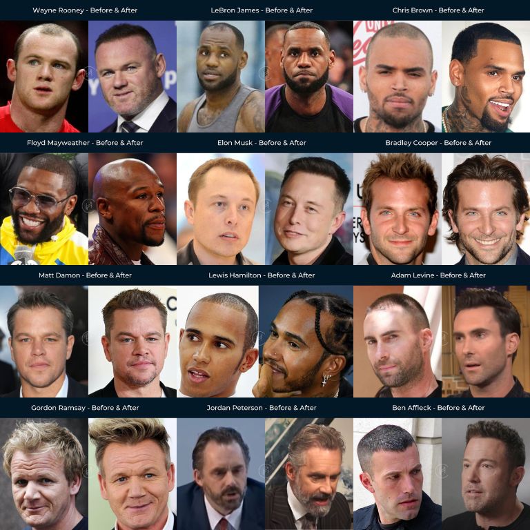 Celebrity-hair-transplants.jpg
